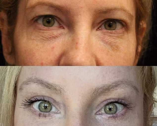 refresh-your-eyes-with-blepharoplasty-raleigh-nc