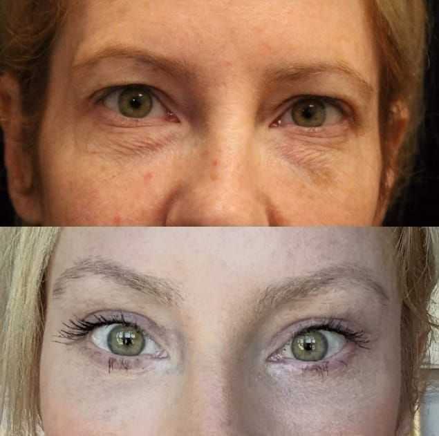 refresh-your-eyes-with-blepharoplasty-raleigh-nc-big-0