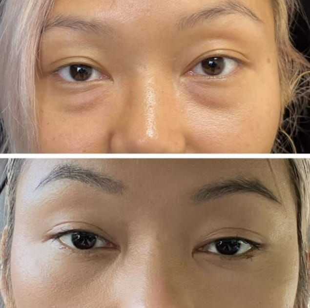 refresh-your-eyes-with-blepharoplasty-raleigh-nc-big-1