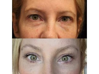 refresh-your-eyes-with-blepharoplasty-raleigh-nc-small-0
