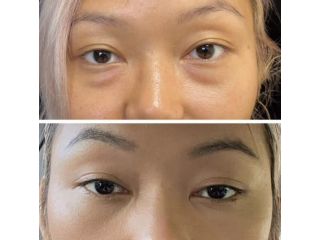 refresh-your-eyes-with-blepharoplasty-raleigh-nc-small-1
