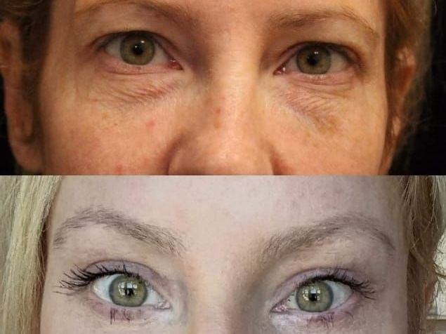 refresh-your-eyes-with-blepharoplasty-raleigh-nc