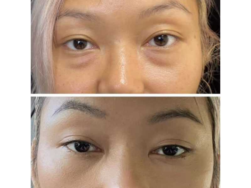 refresh-your-eyes-with-blepharoplasty-raleigh-nc-small-1