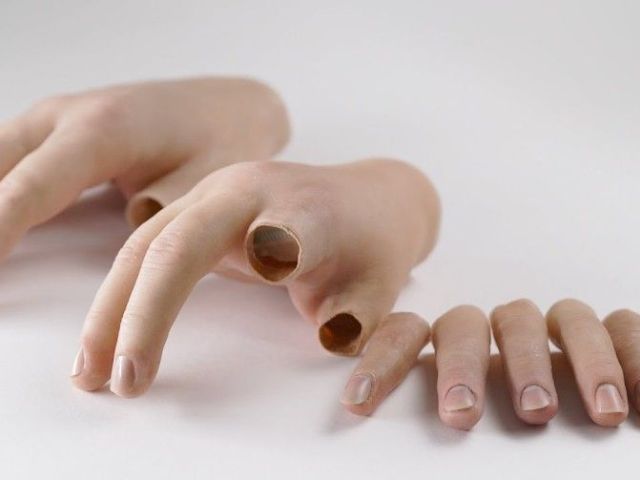 partial-hand-prosthetics-cost-guide-and-custom-options