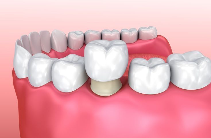 cosmetic-dental-crowns-veneers-in-perris-dr-tejas-modi-big-0