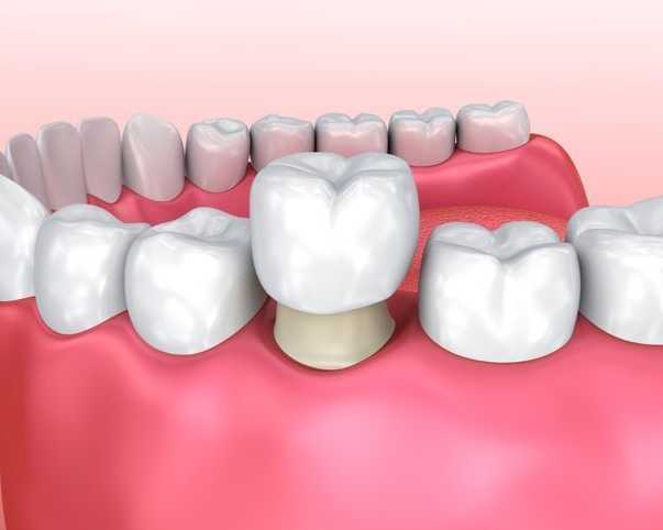 cosmetic-dental-crowns-veneers-in-perris-dr-tejas-modi