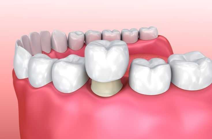 cosmetic-dental-crowns-veneers-in-perris-dr-tejas-modi-big-0