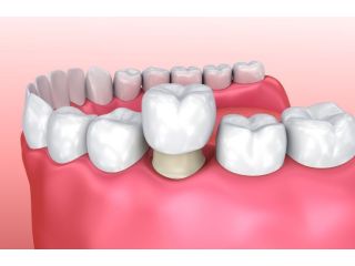 cosmetic-dental-crowns-veneers-in-perris-dr-tejas-modi-small-0