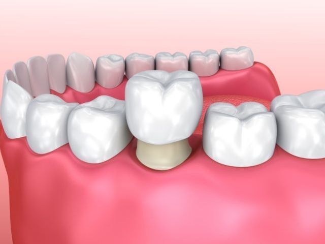 cosmetic-dental-crowns-veneers-in-perris-dr-tejas-modi