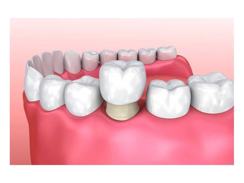 cosmetic-dental-crowns-veneers-in-perris-dr-tejas-modi-small-0