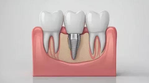 trusted-dental-implant-clinic-in-wilmington-nc-big-0