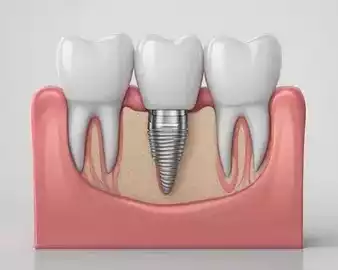 trusted-dental-implant-clinic-in-wilmington-nc
