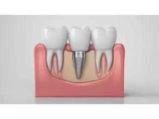 trusted-dental-implant-clinic-in-wilmington-nc-small-0