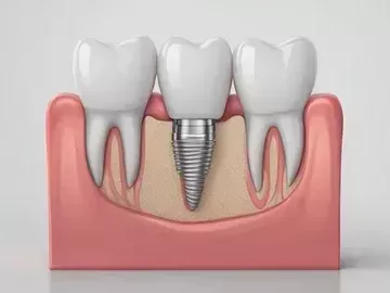 trusted-dental-implant-clinic-in-wilmington-nc