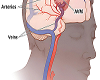 dvt-doctor-in-bilaspur-chhattisgarh