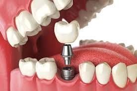 advanced-dental-implants-in-dubai-for-natural-smile-restoration-big-0