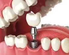 advanced-dental-implants-in-dubai-for-natural-smile-restoration