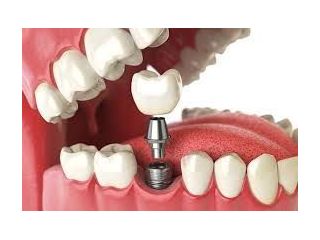 advanced-dental-implants-in-dubai-for-natural-smile-restoration-small-0