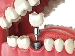 advanced-dental-implants-in-dubai-for-natural-smile-restoration