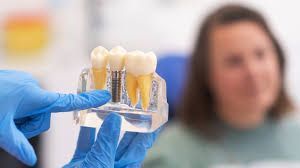 missing-teeth-restore-your-smile-with-affordable-dental-implants-big-0