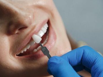 dental-implants-in-mesa-az-for-a-confident-smile