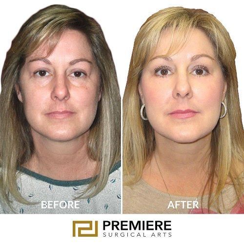 is-the-scarless-breast-lift-really-free-of-scars-big-0