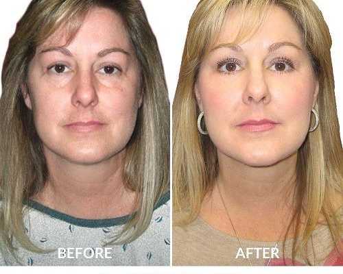 is-the-scarless-breast-lift-really-free-of-scars