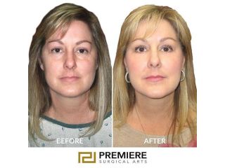 is-the-scarless-breast-lift-really-free-of-scars-small-0