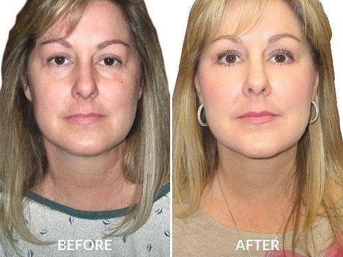 is-the-scarless-breast-lift-really-free-of-scars