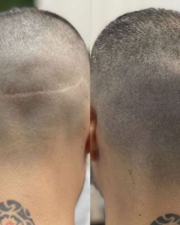 scar-camouflage-tattoo-big-0