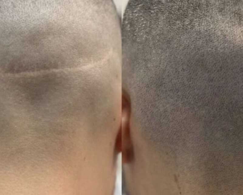 scar-camouflage-tattoo