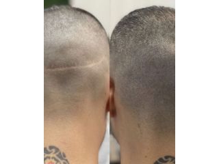 scar-camouflage-tattoo-small-0