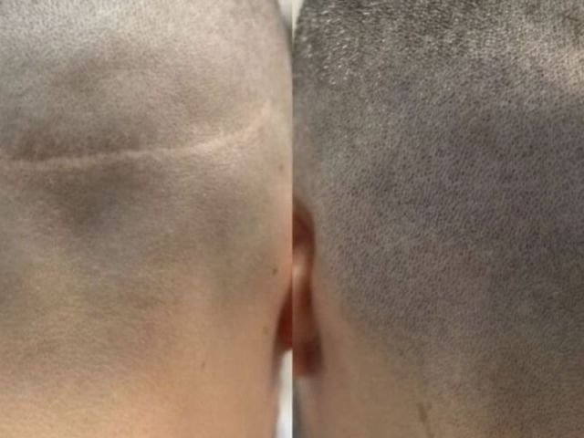 scar-camouflage-tattoo