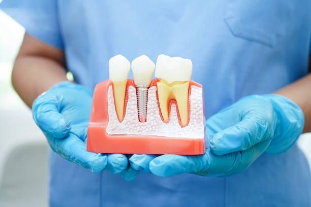 safe-and-reliable-dental-implant-solutions-big-0