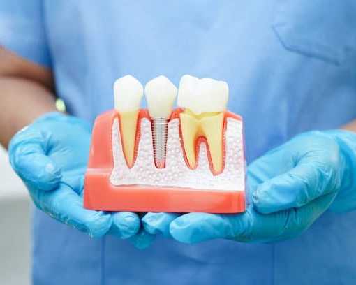 safe-and-reliable-dental-implant-solutions