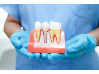 safe-and-reliable-dental-implant-solutions-small-0