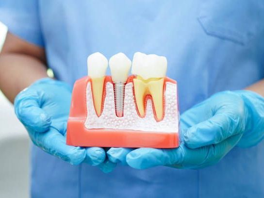 safe-and-reliable-dental-implant-solutions