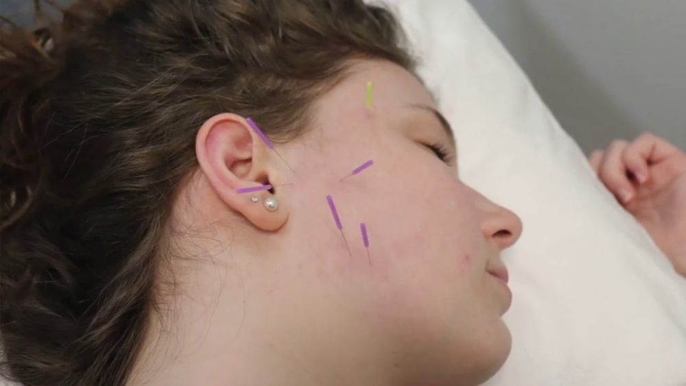 dry-needling-for-tmj-big-0