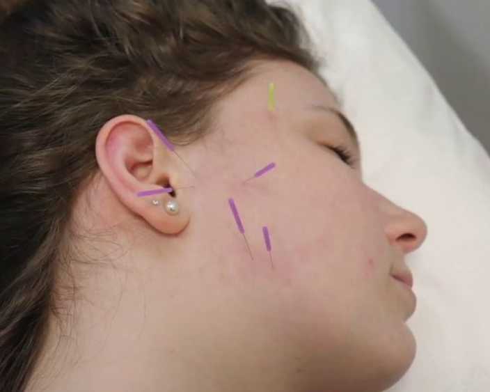 dry-needling-for-tmj