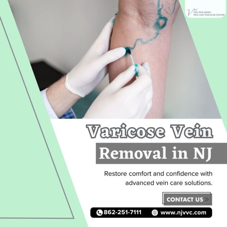 varicose-vein-removal-in-nj-big-0