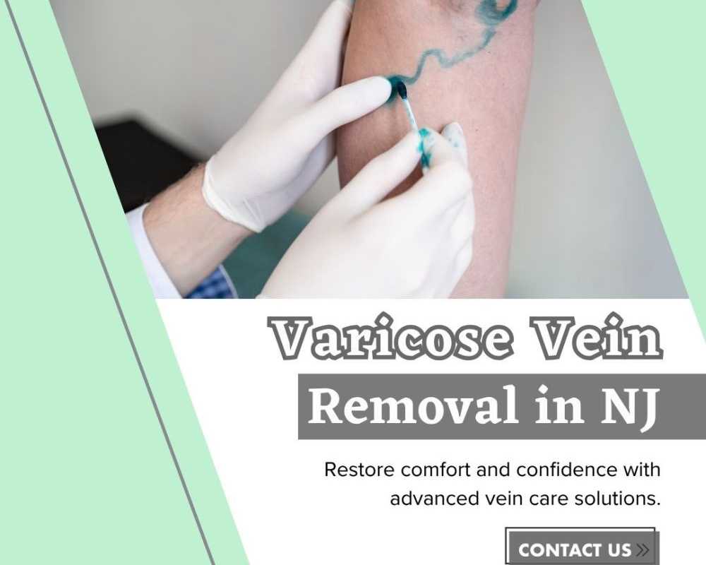 varicose-vein-removal-in-nj