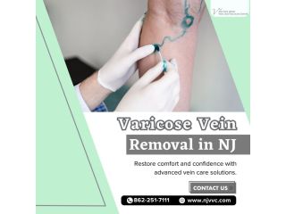varicose-vein-removal-in-nj-small-0