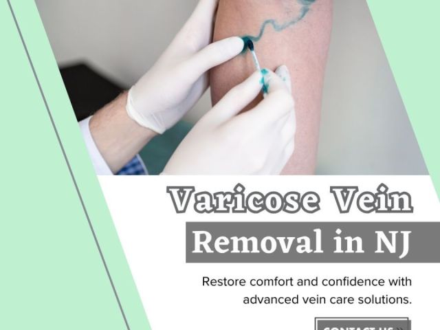 varicose-vein-removal-in-nj
