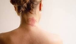 allergic-inflammation-big-0