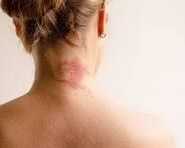 allergic-inflammation