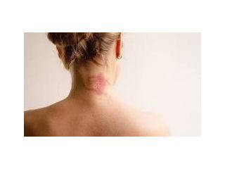 allergic-inflammation-small-0