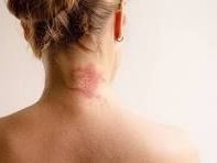 allergic-inflammation