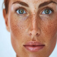 sunspots-treatment-fort-collins-brighten-and-even-skin-tone-big-0