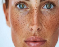 sunspots-treatment-fort-collins-brighten-and-even-skin-tone