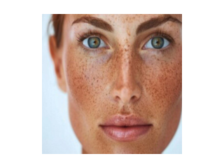 sunspots-treatment-fort-collins-brighten-and-even-skin-tone-small-0